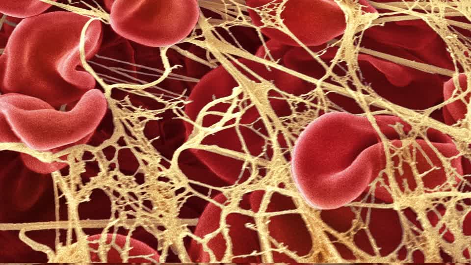 Embalmer Richard Hirschman: Mysterious clotting found in 65% of deceased vaccinated individuals – NaturalNews.com