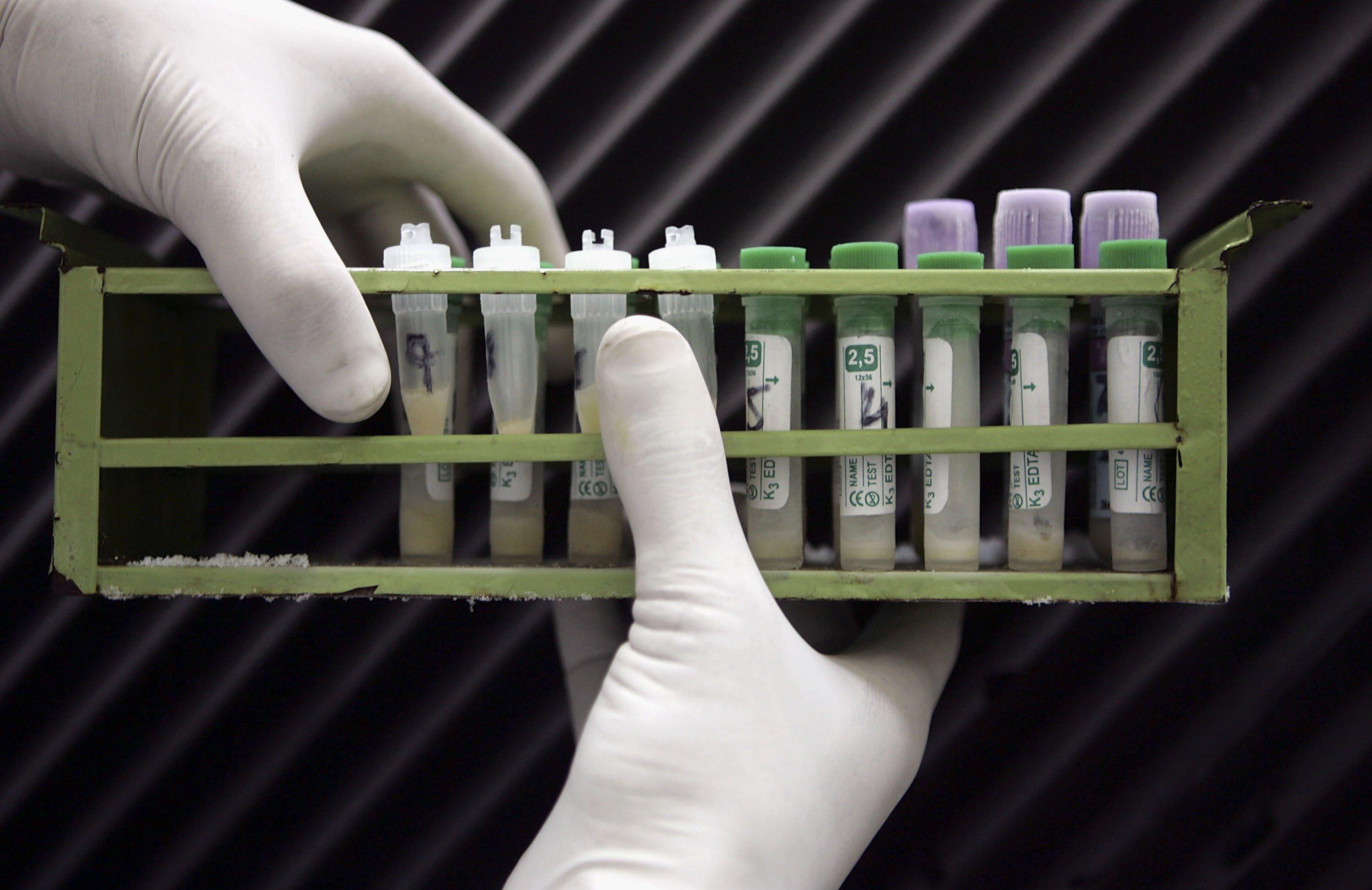 Newly Discovered HIV Variant Can Cause Patients To Develop AIDS Twice As Fast, Researchers Say