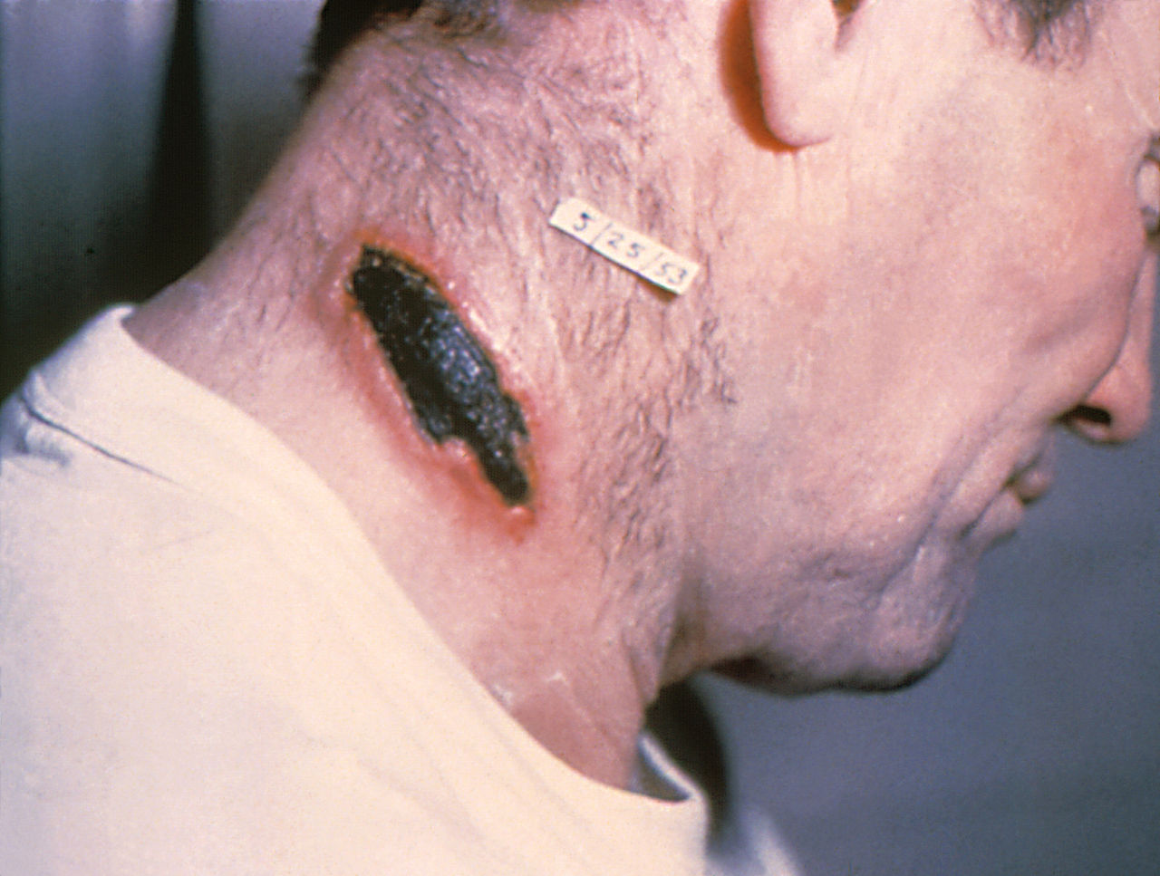 Plague and anthrax to the borders of Russia – World-Signals News