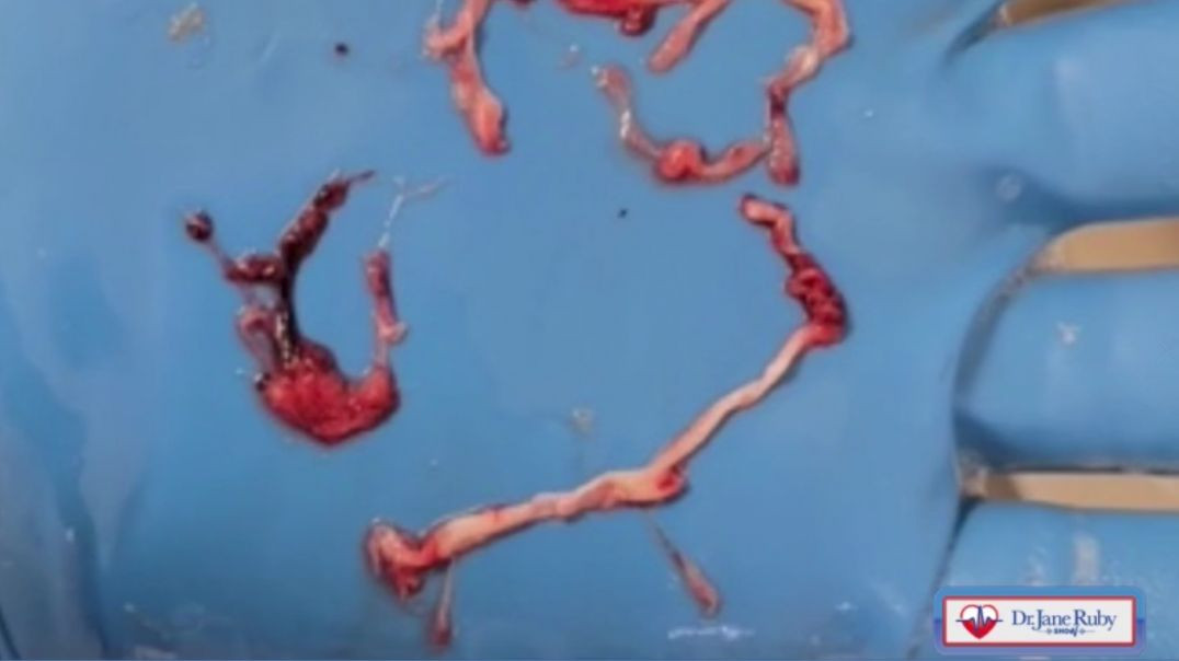 Embalmers Find Veins Arteries Filled with Never Before Seen Rubbery Clots