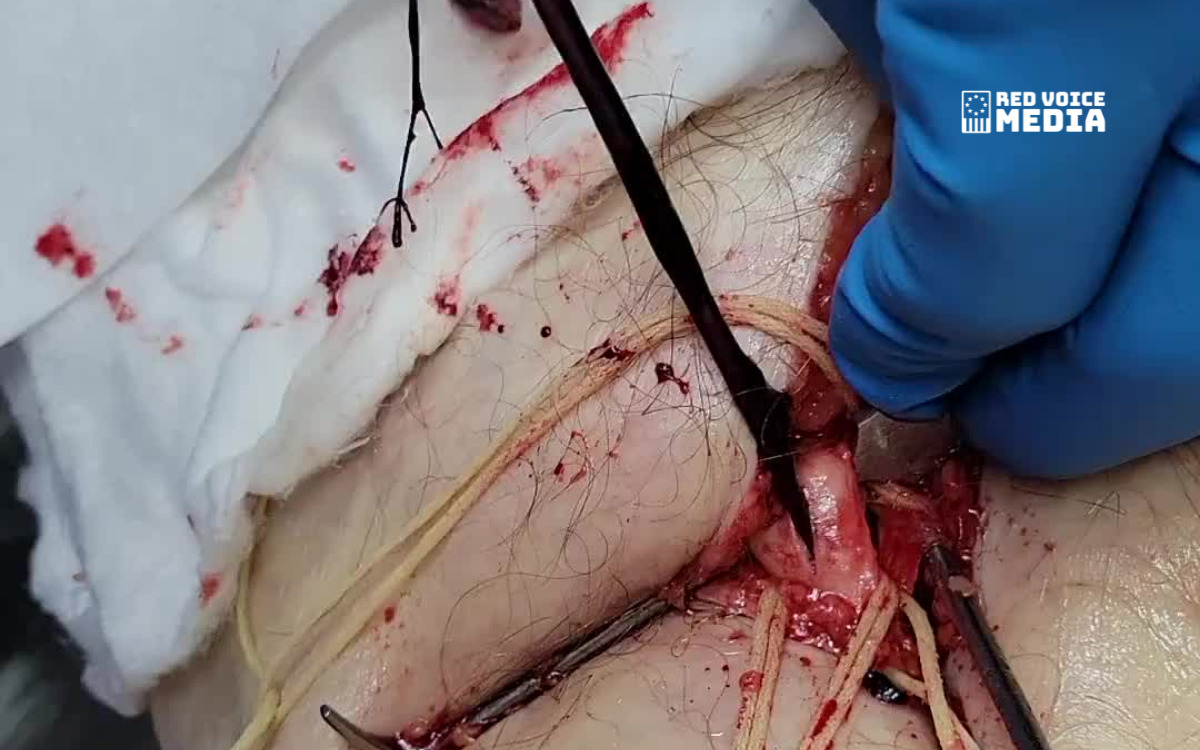 'This Is Not Normal' - Unbelievable Blood Clot Footage Released By Embalmer Richard Hirschman [VIDEO]