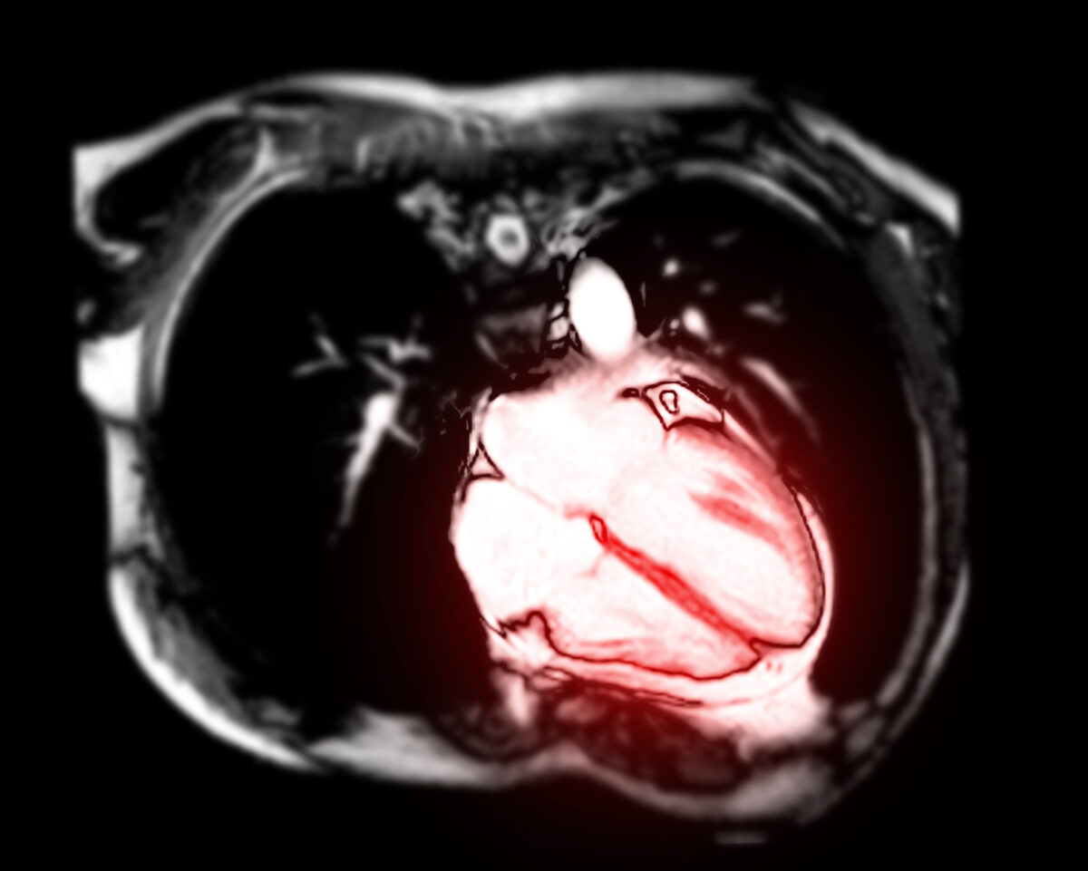 Cardiologist Estimates 30 Percent of U.S. Pilots May Have COVID Jab-Induced Heart Conditions