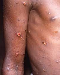 WHO says monkeypox is unlikely to be another ‘pandemic’ | Cairns News