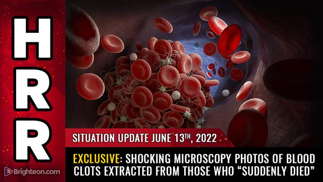 Situation Update, 06/10/22 - EXCLUSIVE: Shocking microscopy photos of blood clots extracted from...