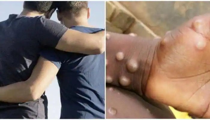 Top health official comments on how monkeypox spreads – Europe Renaissance