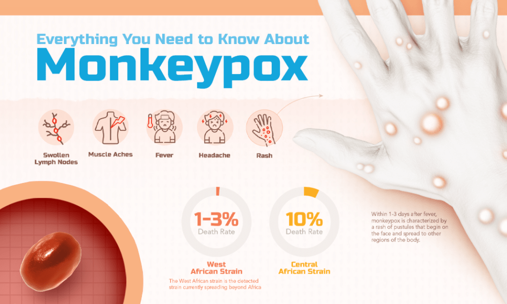 Scientists explain why monkeypox will spread quickly – World-Signals News