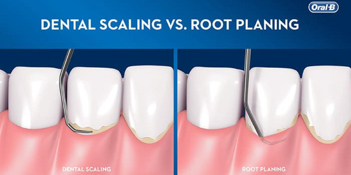 Dental Scaling: The Key to a Healthier Smile