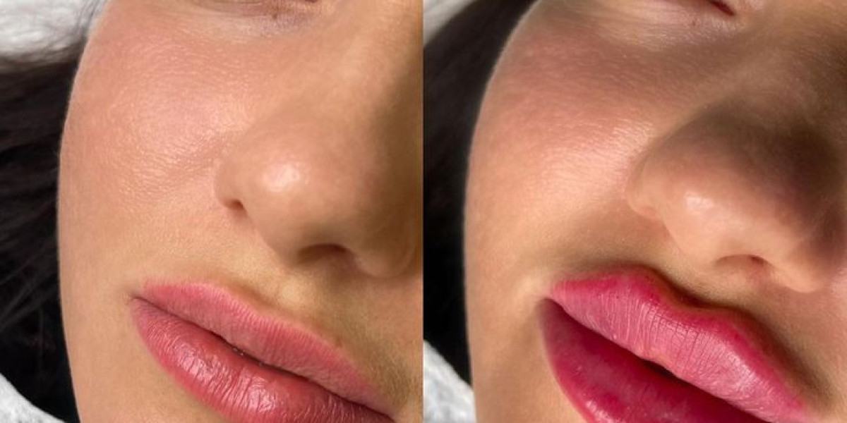 Enhance Your Beauty with Stylage Fillers in Dubai