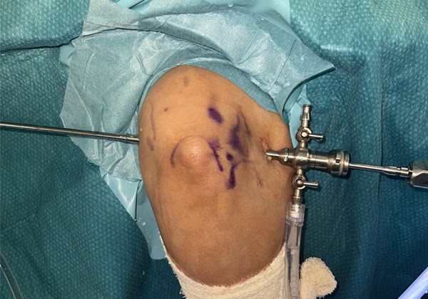 Arthroscopy of the Elbow: A Minimally Invasive Solution for Elbow Pain and Injury
